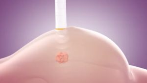 Savi Scout, Savi Scout Guide, Lumpectomy, MultiCare, Multicare Regional Cancer Center