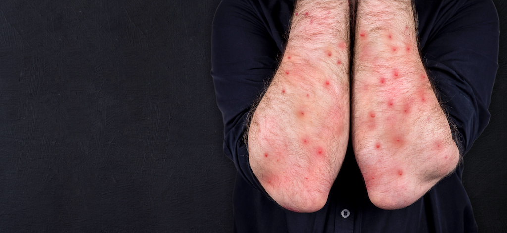 The man's hands are blistered from monkeypox. Virus, epidemic, disease. Black background.
